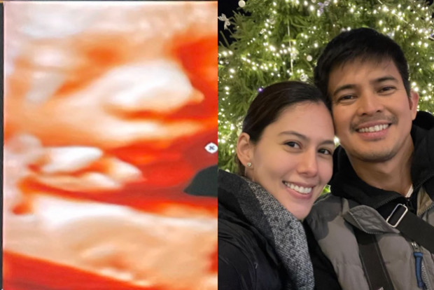 Jason Abalos shows ultrasound of first baby: ‘I can’t wait to see you, my child’
